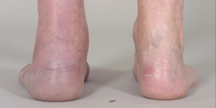 Blauwrode verkleuring van het onderbeen: lymeborreliose? | H&W